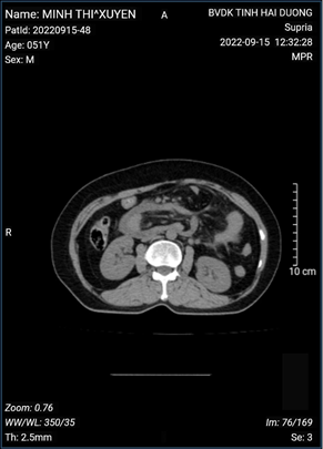 NHÂN MỘT TRƯỜNG HỢP THOÁT VỊ NỘI HIẾM GẶP: THOÁT VỊ CẠNH TÁ TRÀNG (LEFT PARADUODENAL HERNIA)